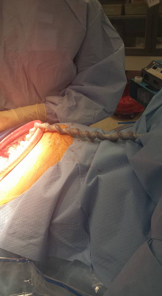 umbilical cord gentle cesarean