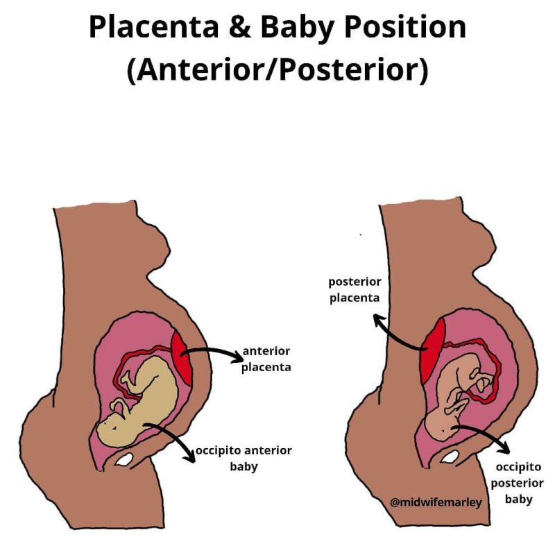 posterior presentation in labour